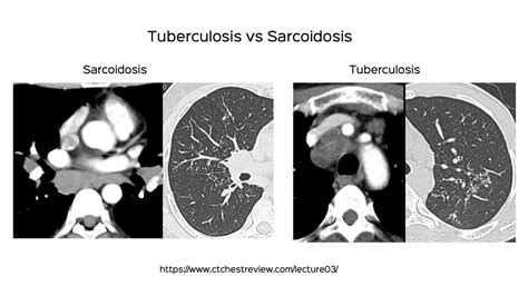 Systematic screening in high risk groups is a possible complement to efforts. . Tb vs chc